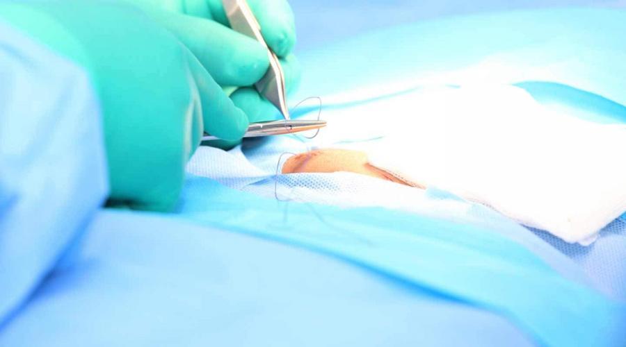 Sütür, sutur, sutür, sütur, ameliyat ipliği, suture, cerrahi dikiş