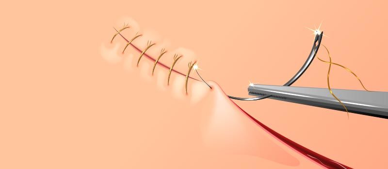 surgical-sutures-glikosorb-nasıl-kullanılır-kullanım-alanları-ameliyat-ipliği-cerrahi