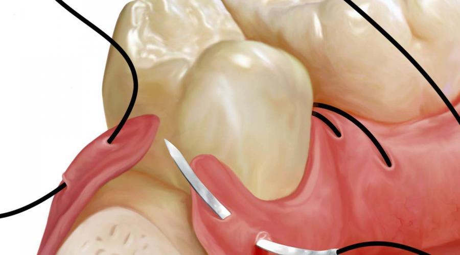 dental-sütür-malzemeleri-suture-ağız-ve-diş-sağlığı-dikiş-ameliyat-ipliği-surgery-çene-cerrahisi