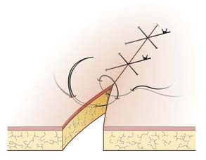 Common Suture Patterns