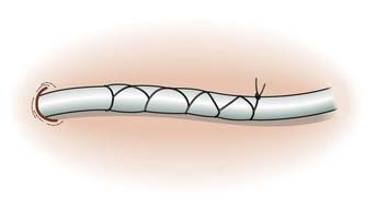 1.12 Chinese Finger Trap Suture.