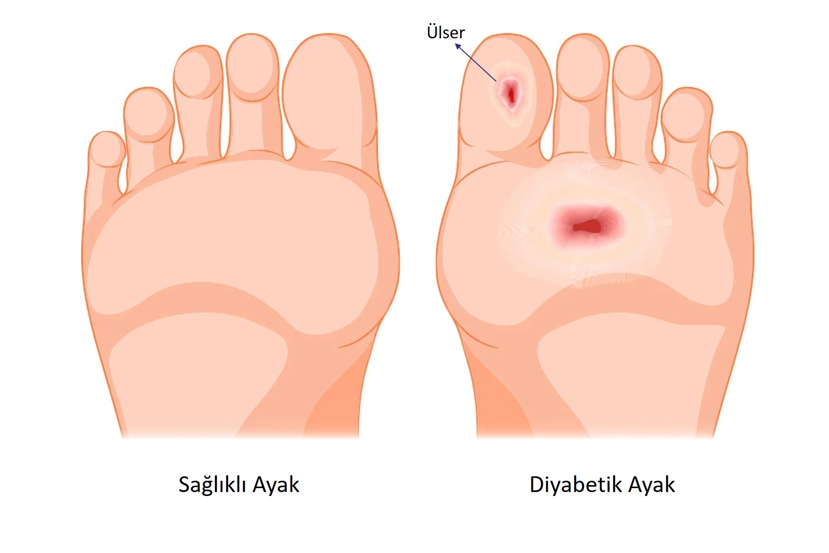 Cicatrices ulcerosas causadas por diabetes en pies