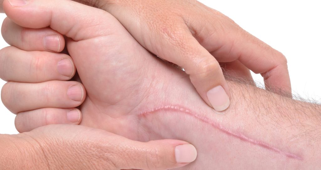 Ejemplo de cicatriz por herida aguda: marca de sutura tras cirugía