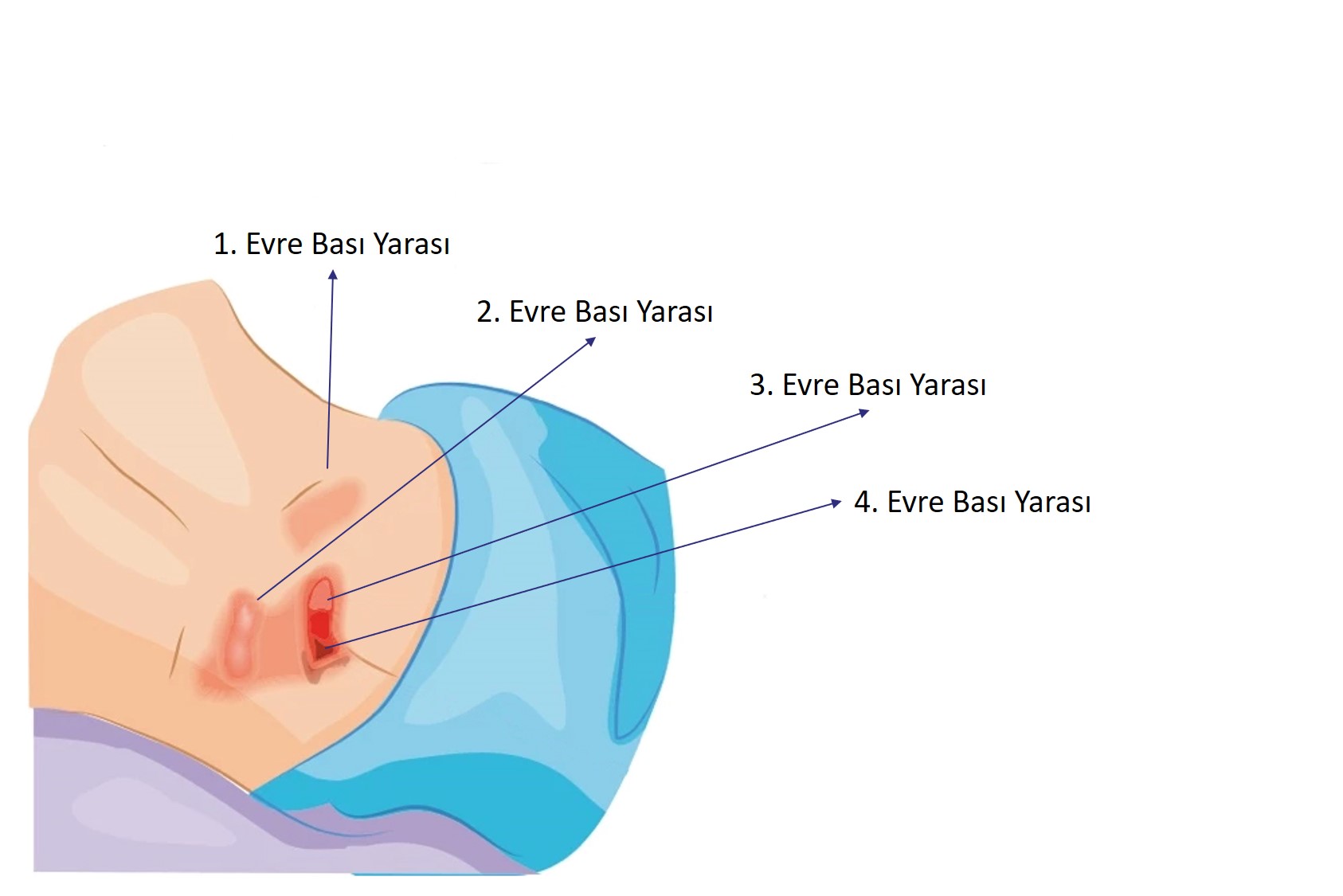 Bed Sore ( Pressure sore/ Decubitus Sore)