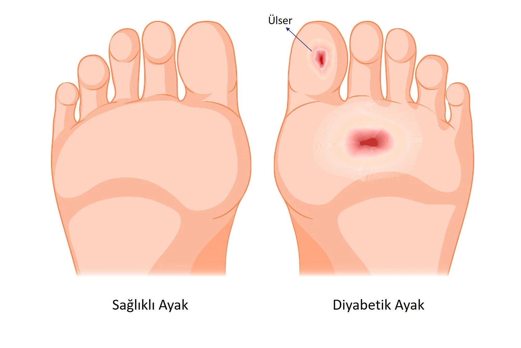 Diyabet Hastalığından Kaynaklı Ayaklarda Meydana Gelen Ülser Yaraları