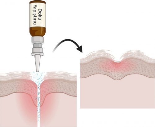 Sentetik doku yapıştırıcı kanama durdurucu hemostatik ajan, hemostat