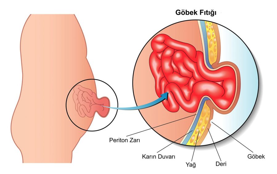 Fıtık anatomisi. Fıtık nasıl anlaşılır? Göbek fıtığı anatomisi.