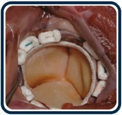 Teflon Pledget Emilemeyen Cerrahi Keçe Kullanımı - What Are The Teflon Pledget Surgical Pledget Felt Usage Areas?