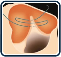 Teflon Pledget Emilemeyen Cerrahi Keçe Kullanımı - What Are The Teflon Pledget Surgical Pledget Felt Usage Areas?